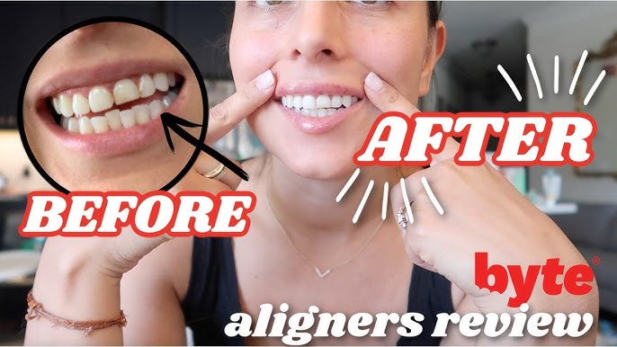 Byte Teeth Aligners